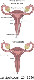 Fertilización in vitro.
Obtener un huevo para inseminación artificial. Fertilidad. Enfermedades del sistema reproductivo femenino. Implantación de embriones en el útero.