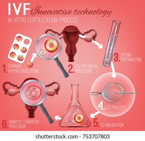 In Vitro Fertilization process image. Artificial insemination infographic. Scientific medical illustration in details. Beautiful vector design in light pink colors.