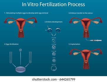 In vitro fertilization process. Medical illustration. Vector.