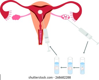 In vitro fertilization scheme 
