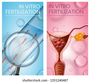 In Vitro Fertilization Vertical Banner Set. IVF. Woman Uterus with Implanted Embryos. Magnifier Close Up View on Test Tube with Active Flowing Sperm. Vector Realistic Illustration. Banner, Copy Space.