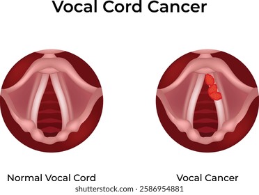 Vocal Cord Cancer Design Vector Illustration