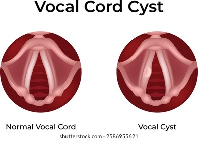 Vocal Cord Cyst Normal vs Affected Design Vector Illustration