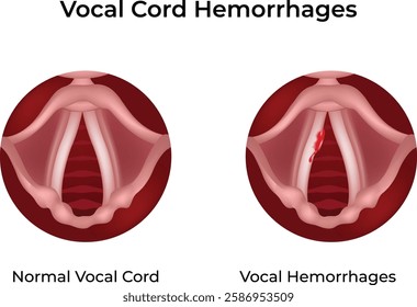 Vocal Cord Hemorrhage Design Vector Illustration