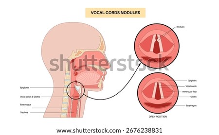 Vocal cord nodules. Benign, bilateral callus like lesions from phonotrauma. Overuse, strain, shouting, singing. Symptoms like hoarseness, dysphonia, vocal fatigue. Laryngoscopy or stroboscopy vector