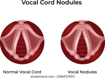 Vocal Cord Nodules Design Vector Illustration