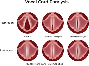 Vocal Cord Paralysis Normal vs Affected Design Vector Illustration