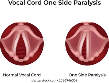 Vocal Cord Paralysis One Side Design Vector Illustration