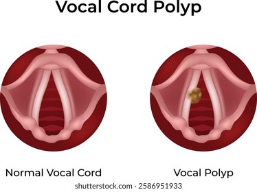 Vocal Cord Polyp vs Normal Vocal Cord Design Vector Illustration