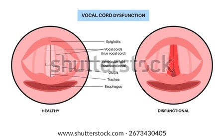 Vocal cords dysfunction medical poster. Clinical airway disorder, the vocal folds close abnormally during inspiration or expiration. Breathing difficulty, stridor, cough, and voice changes flat vector