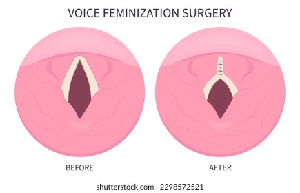 Voice Feminization Surgery male to female of Adam's procedure face speech estrogen exercise affirming care