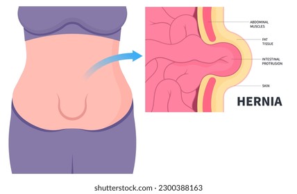 Abdominal Muscles PNG Transparent Images Free Download, Vector Files