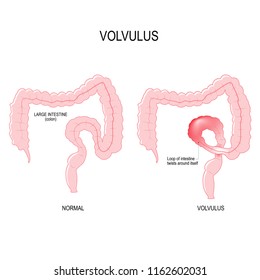 Volvulus is a loop of intestine twists around itself. anatomical of the colon. Close-up of the large intestinal. Vector illustration for biology, scientific, and medical use.