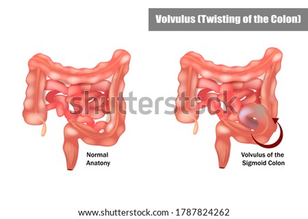 Volvulus of the Sigmoid Colon. Twisting of the Colon