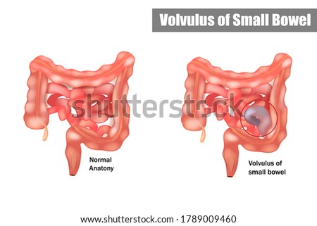 Volvulus of Small Bowel. A length of small intestine has twisted around itself, cutting off blood circulation to the twisted loop.