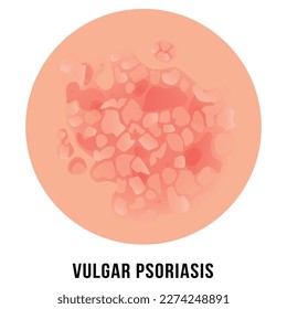 Vulgar psoriasis not pustular type eczema skin disease dermatitis infographic scheme place for text vector flat illustration. Dermatology chronic allergen human immune illness medical inflammation