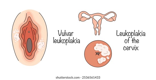 Leucoplasia vulvar e leucoplasia do colo do útero. Lesão distrófica do epitélio escamoso estratificado dos órgãos genitais femininos e do colo do útero na forma de placas brancas leitosas. Vetor de cores.