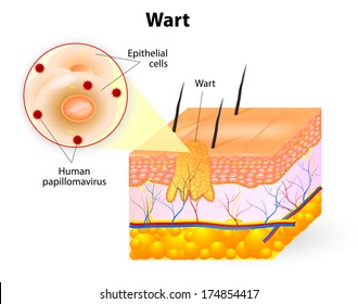 Wart Anatomy. Warts Are Benign Skin Growths That Appear When A Human Papillomavirus (HPV) Infects The Top Layer Of The Skin.