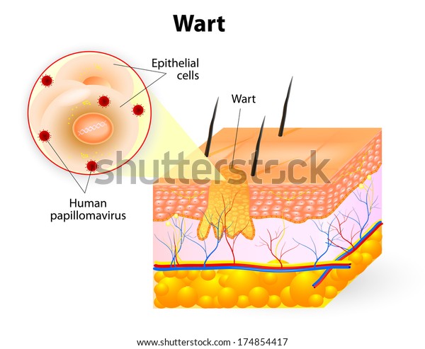Wart anatomy. Warts are benign skin growths that\
appear when a human papillomavirus (HPV) infects the top layer of\
the skin.