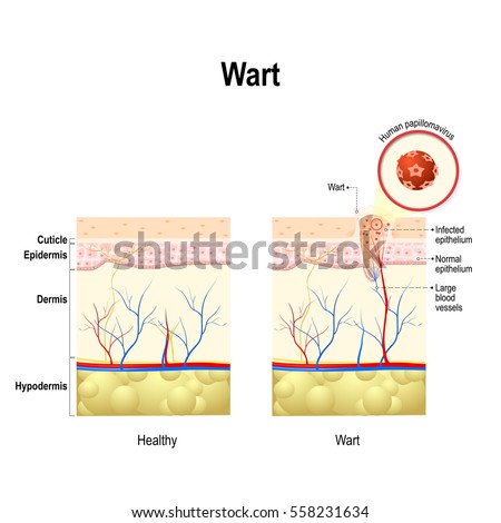 wart cross section human skin human stock vector (royalty free Diagram of Fever wart cross section of the human skin with human papillomavirus infection hpv is a