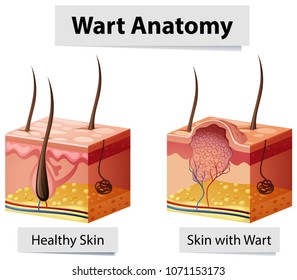 Wart Human Skin Anatomy Illustration illustration