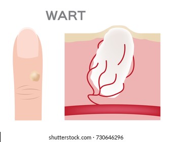 Wart on a person's hand close up