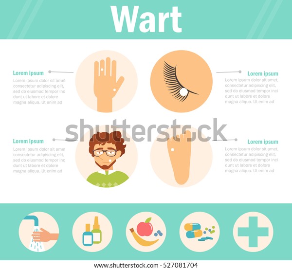 Wart Types On Hand Foot Eye Stock Vector (Royalty Free) 527081704 Shutterstock