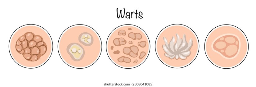 Warzen. Gutartige Hautneoplasmen viraler Ätiologie, die das Aussehen eines Knötchens oder einer Papille aufweisen. Die wichtigsten Arten von Warzen, die auf der menschlichen Haut gefunden werden. Vektorgrafik zum Thema Hautkrankheiten.