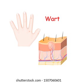 warts on a hand. cross section of detailed wart. Vector illustration for medical use