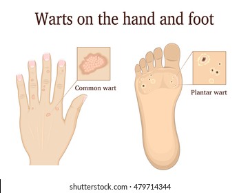 Warts On The Hand And Foot Depicted In General And Close-up