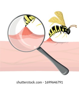 Wasp sting human. Close up detailed with magnifier pathogenesis of bee stings and allergic reaction. Vector illustration in cartoon relistic style. Medical poster, anaphylaxis, summer danger. insect
