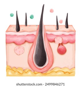 Watercolor Illustration of Hair Follicle with Clogged Pore and Pimples