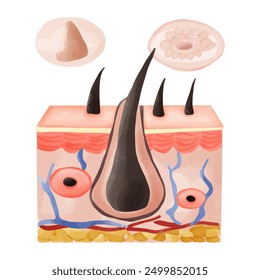 Watercolor Illustration of Hair Follicle with Follicular Hyperkeratosis