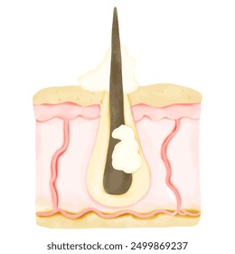 Watercolor Illustration of Hair Follicle with Sebum Overproduction