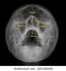 Waters xray paranasal sinus anatomy 