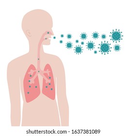 Ways Of Infection With Viruses. Airborne Transmission Of The Virus. – Stock Illustration 