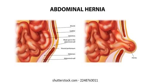 Debilidad en la pared abdominal. Hernia abdominal. Ilustración vectorial.