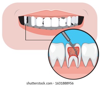 Weakness with caries and pulpitis as a concept of problems with front teeth. Vector stock illustration with caries treatment of molars and incisors for dental services and design.