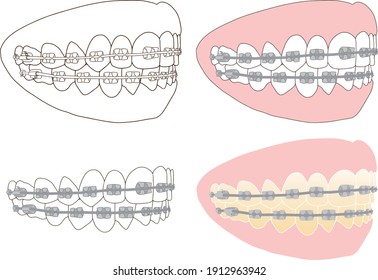 Wearing metal brackets for correct teeth and orthodontic treatment