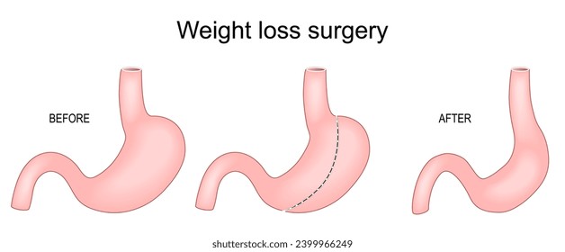 Weight loss surgery. Sleeve gastrectomy. Bariatric surgery. Showing the stomach before and after procedure. reduced, new stomach is the gastric sleeve. Vector illustration