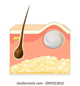 Wen, sebaceous cyst, a form of trichilemmal cyst. Epidermoid or Pilar cysts. Cross section of skin layers with hair follicle and steatocystoma. Vector illustration svg
