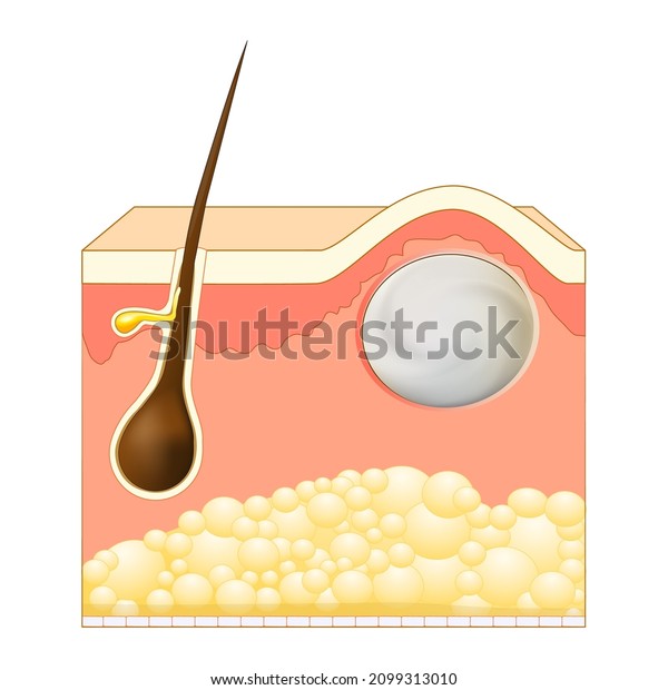 Wen, sebaceous cyst, a\
form of trichilemmal cyst. Epidermoid or Pilar cysts. Cross section\
of skin layers with hair follicle and steatocystoma. Vector\
illustration