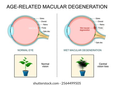 Wet Age-related Macular Degeneration AMD. Cross section of human eye. Vision distortion. Central vision loss. Retinal hemorrhage. Close-up of a macula, optic disc, choroid, retina, sclera, and fovea