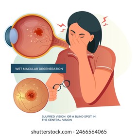 Wet Macular Degeneration - Blurry vision - Stock Illustration as EPS 10 File