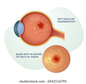 Nasse Makuladegeneration - Stockabbildung als EPS 10 Datei