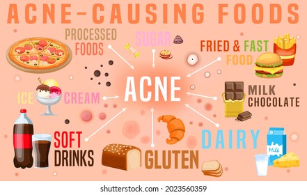 What causes acne. Acne-causing food. Soda, dairy products, ice cream, bread. Skin problems. Common condition. Landscape medical banner with useful information. Editable vector illustration. 