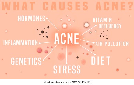 What causes acne poster. Skin disease, dermatology, cosmetology concept. Medical infographics. Scientific background. Landscape banner with useful information. Vector illustration.