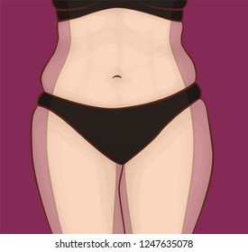 What hides the extra weight. The body of a woman before and after weight loss. Press and hips.