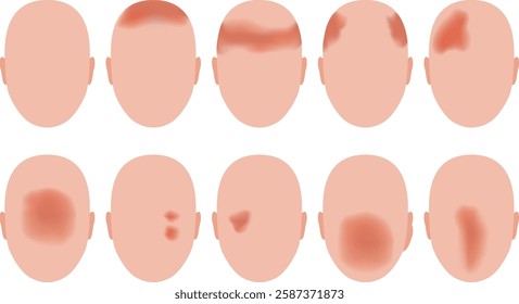 Where a headache occurs. Illustration of a human head.