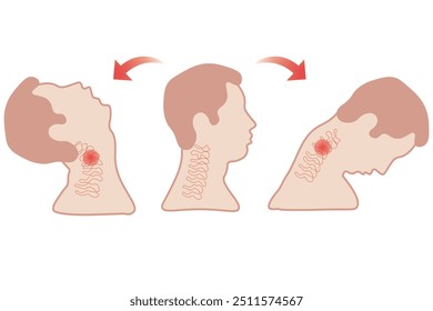 Whiplash,neck injury caused by rapid back-and-forth movement of the head, often from car accidents. Symptoms include neck pain, stiffness, and headaches.  herniated discs, cervical spondylosis.